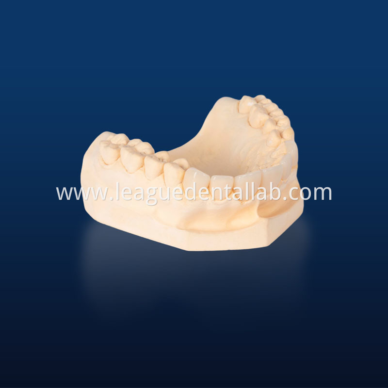 IPS Empress,Emax Onlay,Emax onlay,Emax Veneer,Lithium disilicate